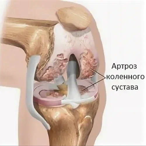 Артроз коленного сустава